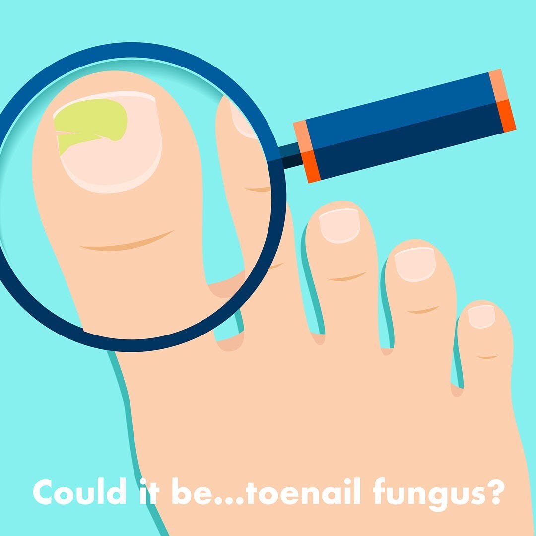 Toenail Fungus Treatment Using Undecylenic Acid Nail Care Hub 