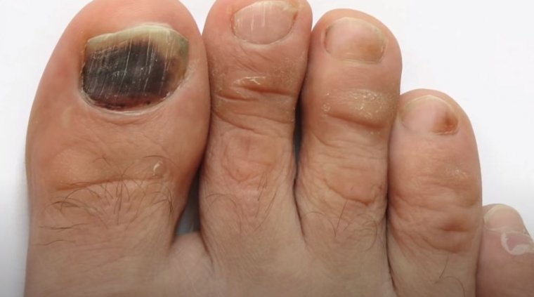 Black Toenail Fungus Causes Treatments And More Nail Care Hub