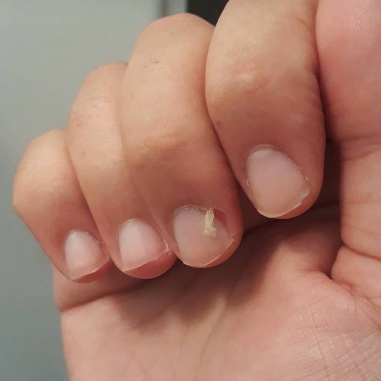 How long should a hangnail hurt?