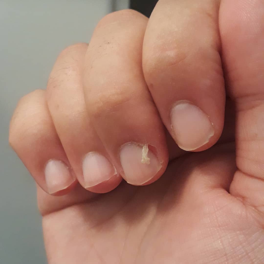 How To Fix A Hangnail Using 4 Essential Steps Nail Care Hub