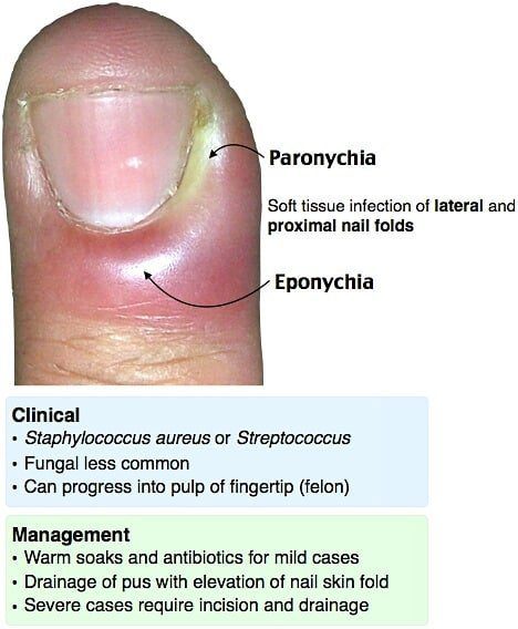 Onychia And Paronychia Causes Symptoms And Treatments Nail Care Hub