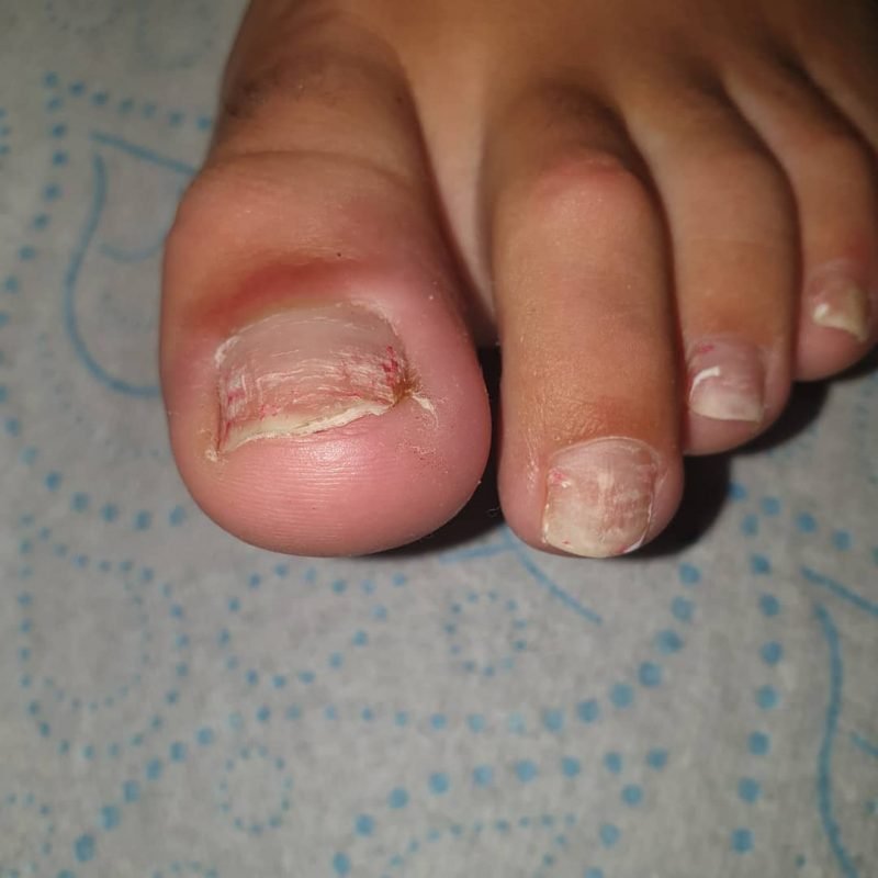 ToeNail Fungus Infection