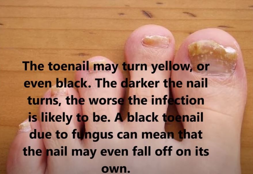 Tell-tale Signs Of Toenail Fungus: Inspect Yourself! | Nail Care Hub