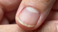 delayed nail growth disruption