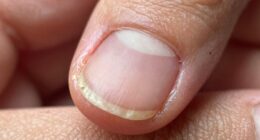 delayed nail growth disruption