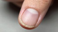 nail healing from stress
