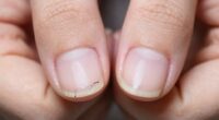 stress causes nail cracks