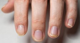 warning signs of nail health